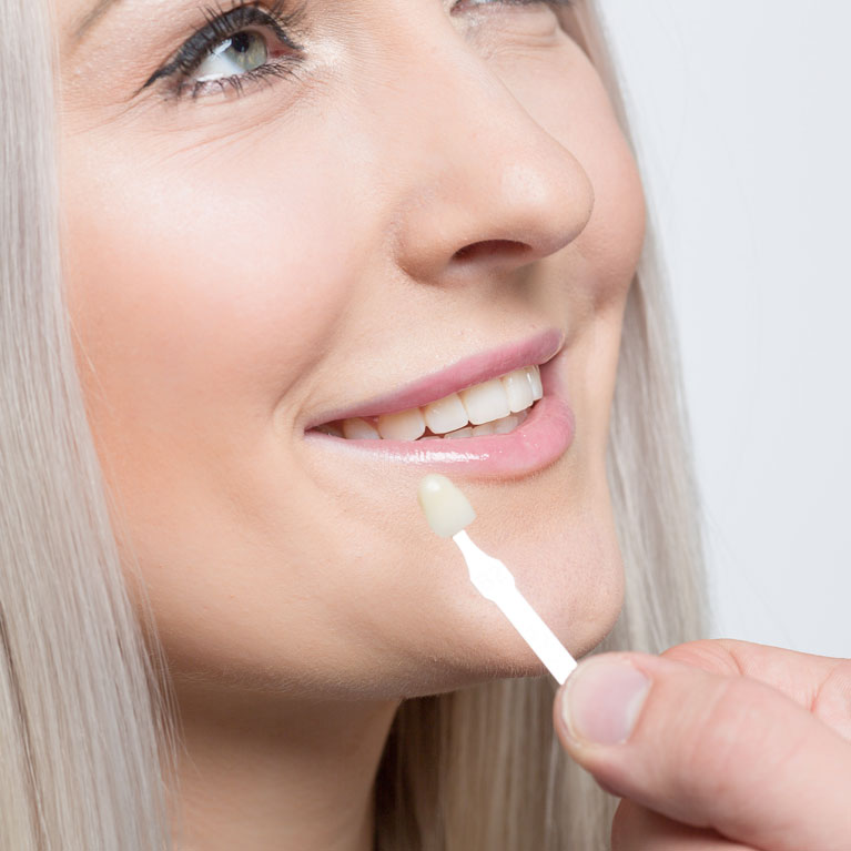 Veneers